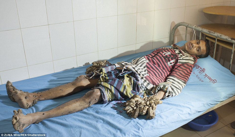 孟加拉国男子患罕见病 手脚增生如树根(组图)