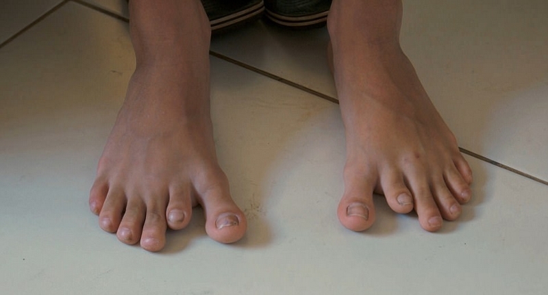 巴西“六指家族”迎小生命继承六指遗传