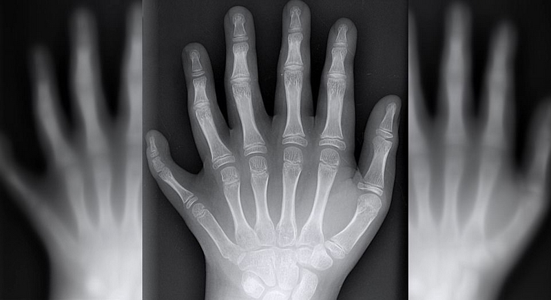 巴西“六指家族”迎小生命继承六指遗传