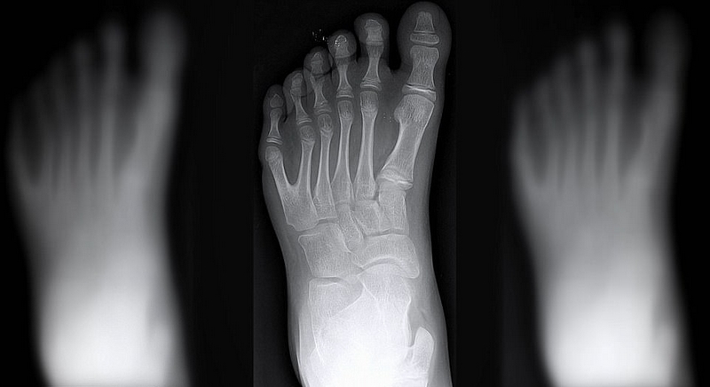 巴西“六指家族”迎小生命继承六指遗传