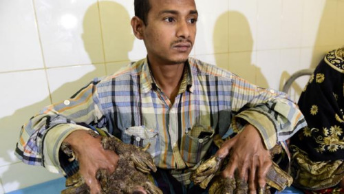 孟加拉“树人”手术成功 切除右手“树根”展笑颜