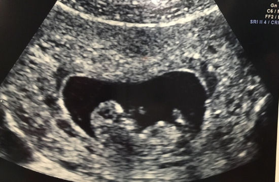 陶昕然宣布怀孕晒B超照 孩子小名叫何陶