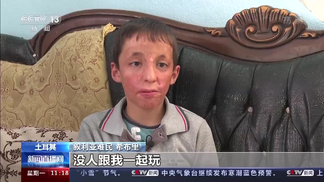 战争中毁容的叙利亚男孩没人跟我一起玩