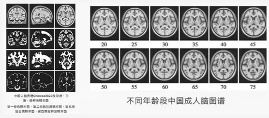 三代人攻堅中國人專屬腦圖譜 破解阿爾茨海默病密碼