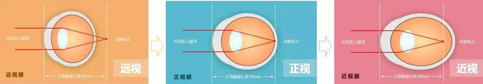 【教育频道】国家儿童医学中心北京儿童医院眼科主任李莉：爱眼护眼 从小抓起