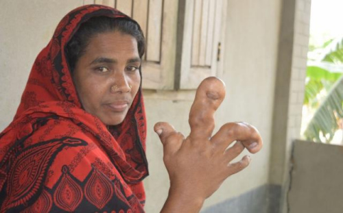 孟加拉女子患罕见病 手上长水泡肿胀大如球(图)