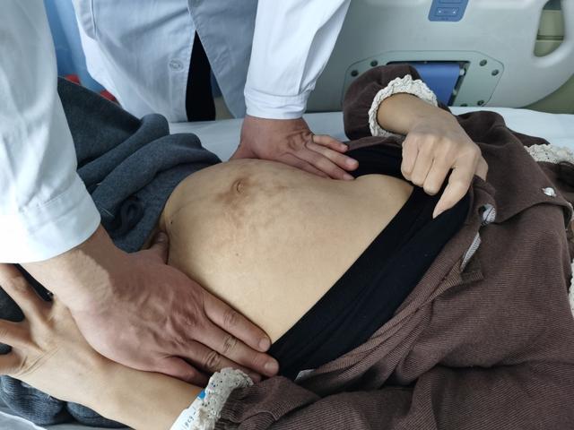 （转载）西安市红会医院消化外科团队从她腹中取出15斤大肿瘤