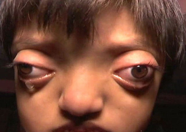 印度女孩患罕见病长"青蛙眼" 饱受痛苦欺凌(组图)