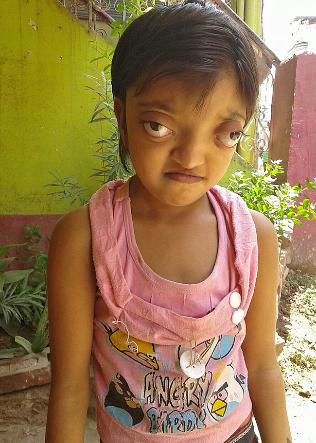 印度女孩患罕见病长青蛙眼 饱受痛苦欺凌(组图)