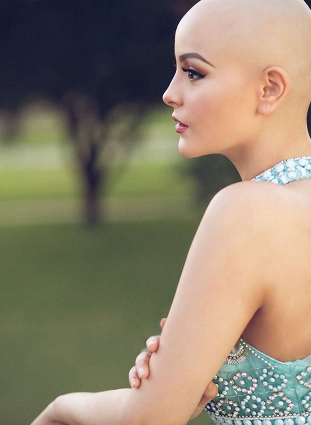 美女模特患癌掉光头发 笑对镜头美丽依然(组图)