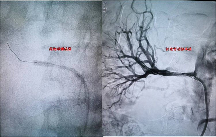 西安交大一附院血管外科杨林团队成功救治未成年肾动脉闭塞患者_fororder_图片3
