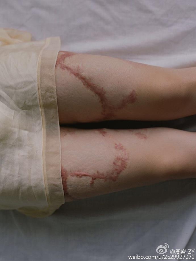 被富二代同学泼汽油烧伤的女孩拍写真获网友大赞