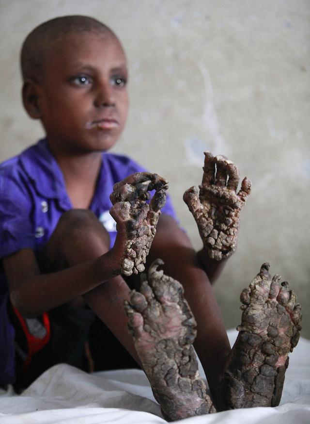 孟加拉国7岁男孩患怪病 手脚长厚皮似树根(组图)