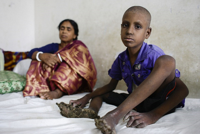 孟加拉国7岁男孩患怪病 手脚长厚皮似树根(组图)