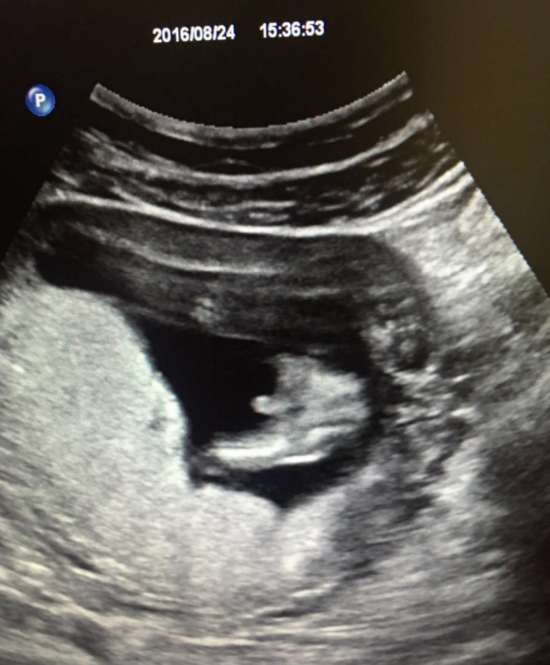 怀孕48天b超图片图片