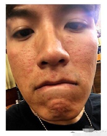 柯震东晒素颜照揭“颜崩”真因:皮肤过敏