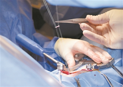 抗炎脊髓贴片可修复椎间盘突出_fororder_3627435_wangjj_1700036732139_b