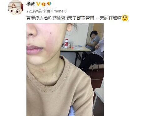 杨紫得了荨麻疹 晒“半脸”自拍照满脸红痕(图)