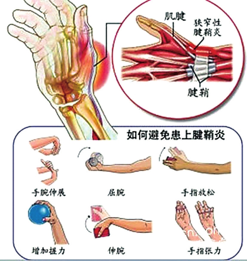 持续不正确用手容易导致腱鞘炎