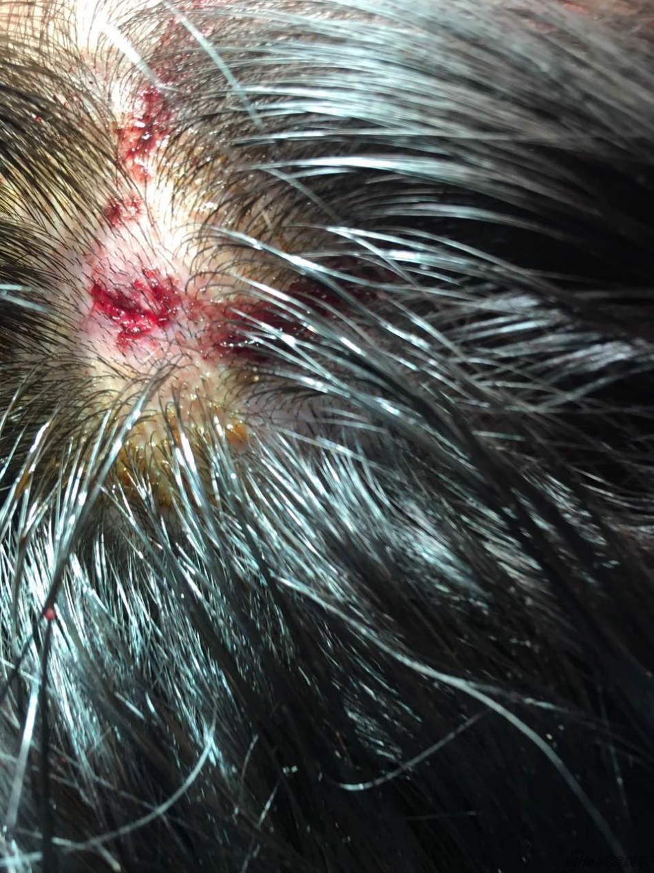 新浪娱乐求证后,黄灿灿受伤属实,头部伤口直径约一厘米,为了不影响