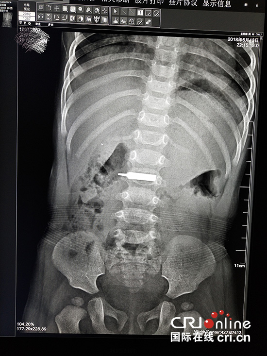 長春市兒童醫院為16個月男童取出誤食螺絲刀頭