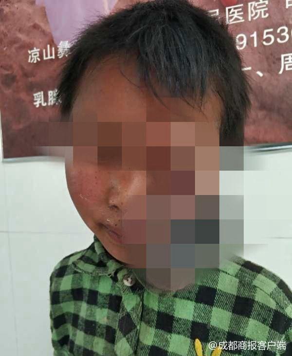 7岁女童全身7处肿瘤散发恶臭 2次手术成功切除