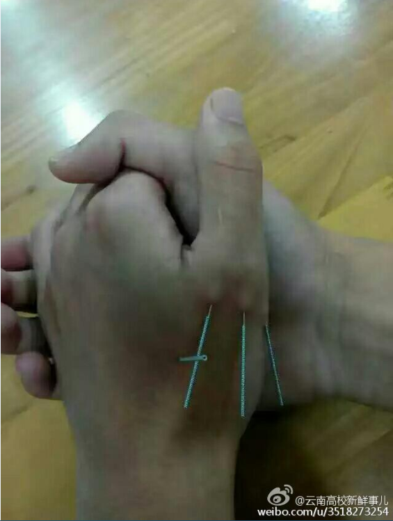 云南某高校学生为复习提神用银针扎自己组图