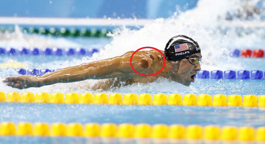 2016年8月8日,美国选手菲尔普斯在蝶泳比赛中,拔火罐痕迹明显