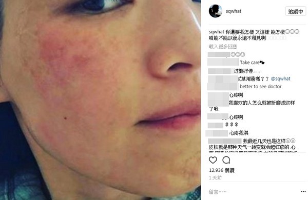 舒淇晒奔溃自拍照 脸部红肿过敏堪比毁容(图)