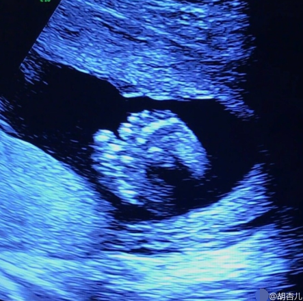 孕五个月男宝b超图图片